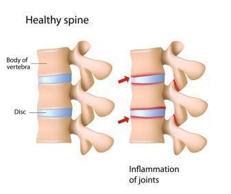 Rheumatoid arthritis in the spine